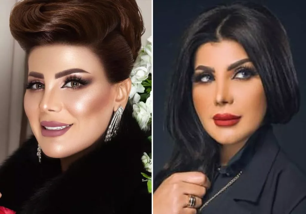 الفنانة الكويتية قبل وبعد فيلر الوجه