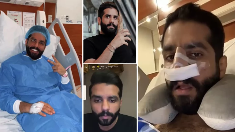 عبدالله الودعاني قبل وبعد التجميل في 20 لقطة،غير ملامحه ورد على تقليد شقيقته